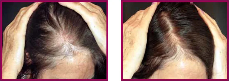 Scalp Stimulation – Tratament Natural pentru Creșterea și Regenerarea Părului